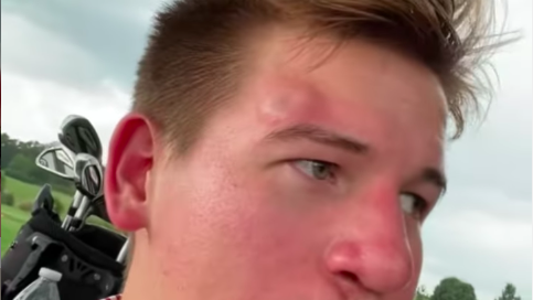 Unlucky golfer gets MASSIVE BUMP on the head after being hit by golf ball